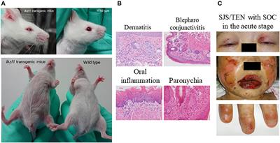 Pathogenesis of Stevens-Johnson Syndrome/Toxic Epidermal Necrolysis With Severe Ocular Complications